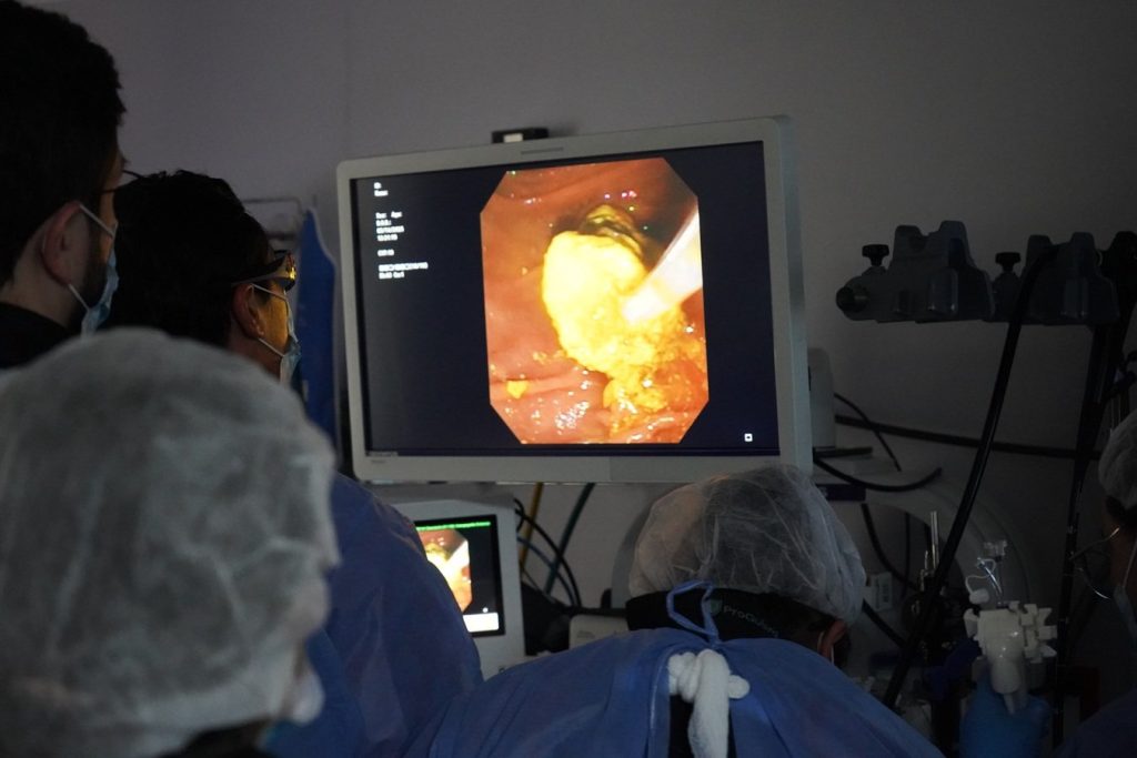 Colombia realiza primera ablación en la vía biliar con catéter Habib por radiofrecuencia