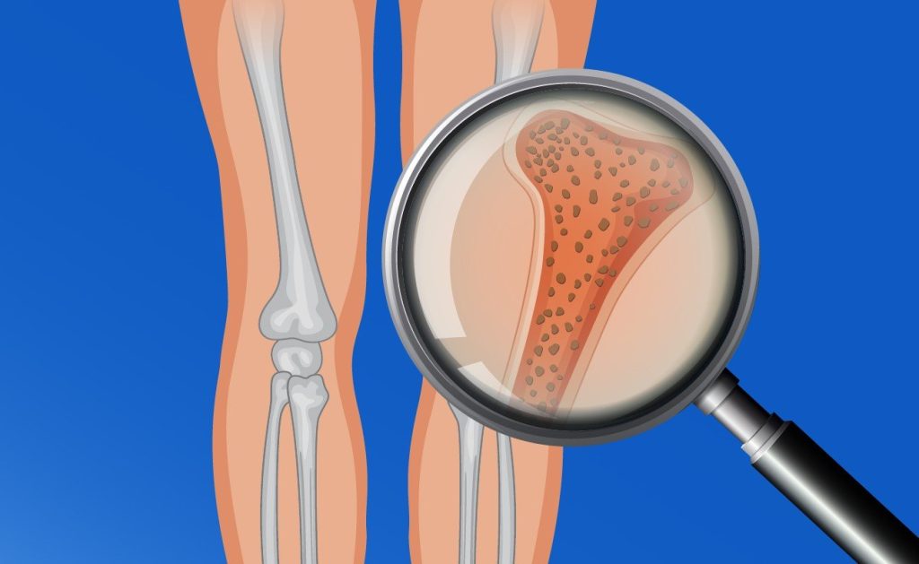 Osteoporosis: enfermedad silenciosa que requiere atención especializada