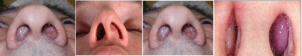 Poliposis nasal: enfermedad poco conocida que afecta la vida diaria