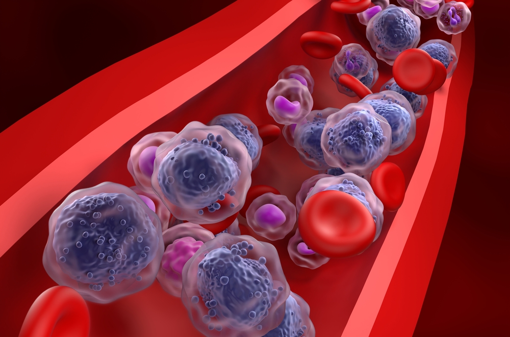 ¿Qué es la leucemia mieloide aguda? la primera con más casos nuevos cada año